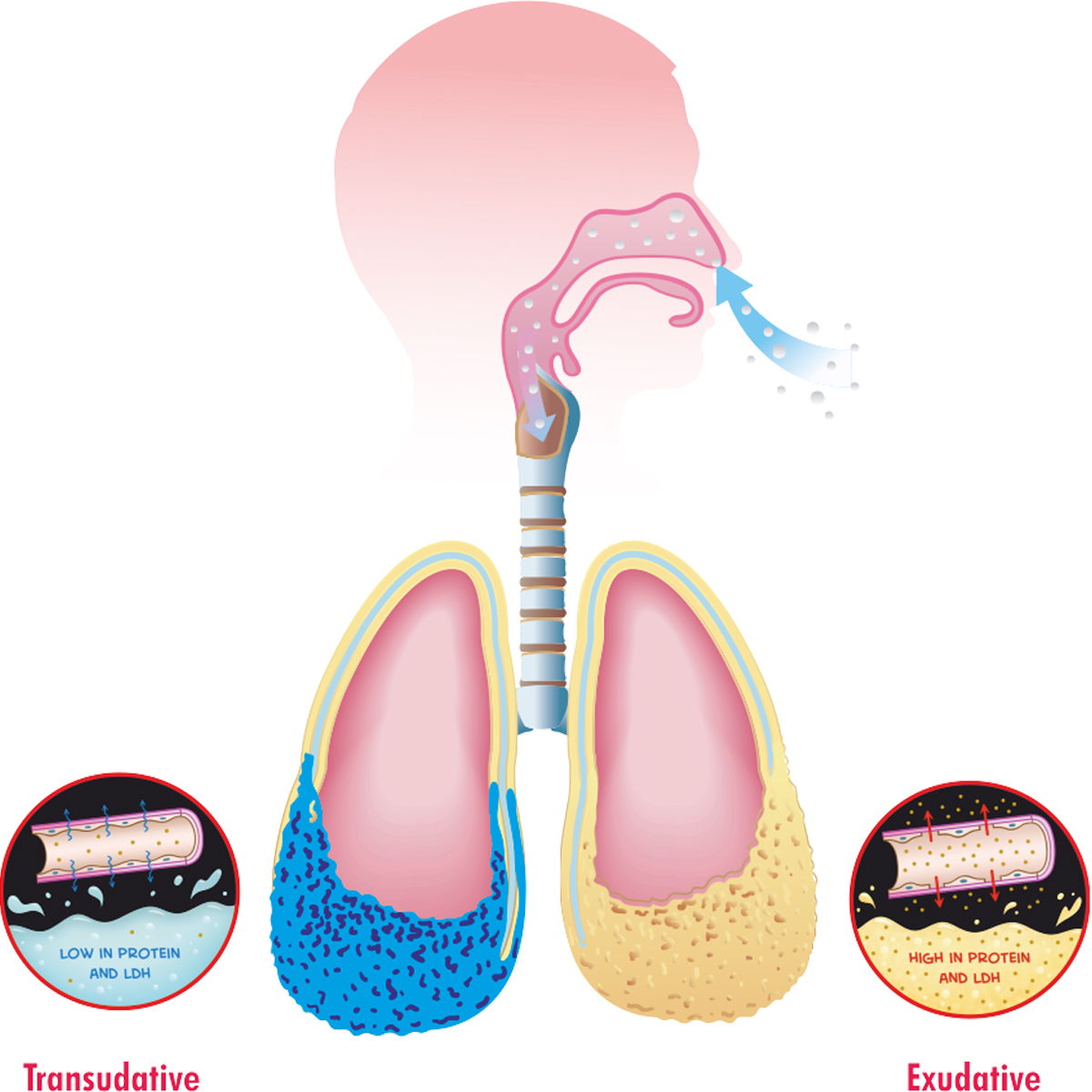 pleural effusion symptoms